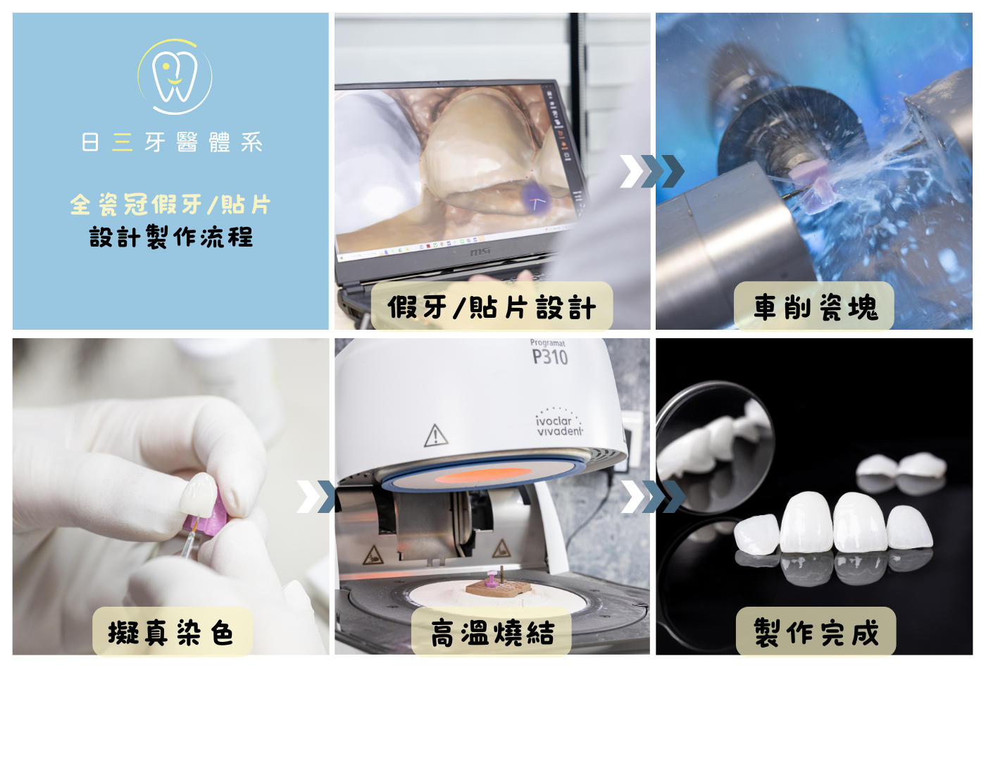 全瓷冠懶人包|全瓷冠是什麼?費用、材質、療程步驟全指南 配戴臨時牙冠等待製作