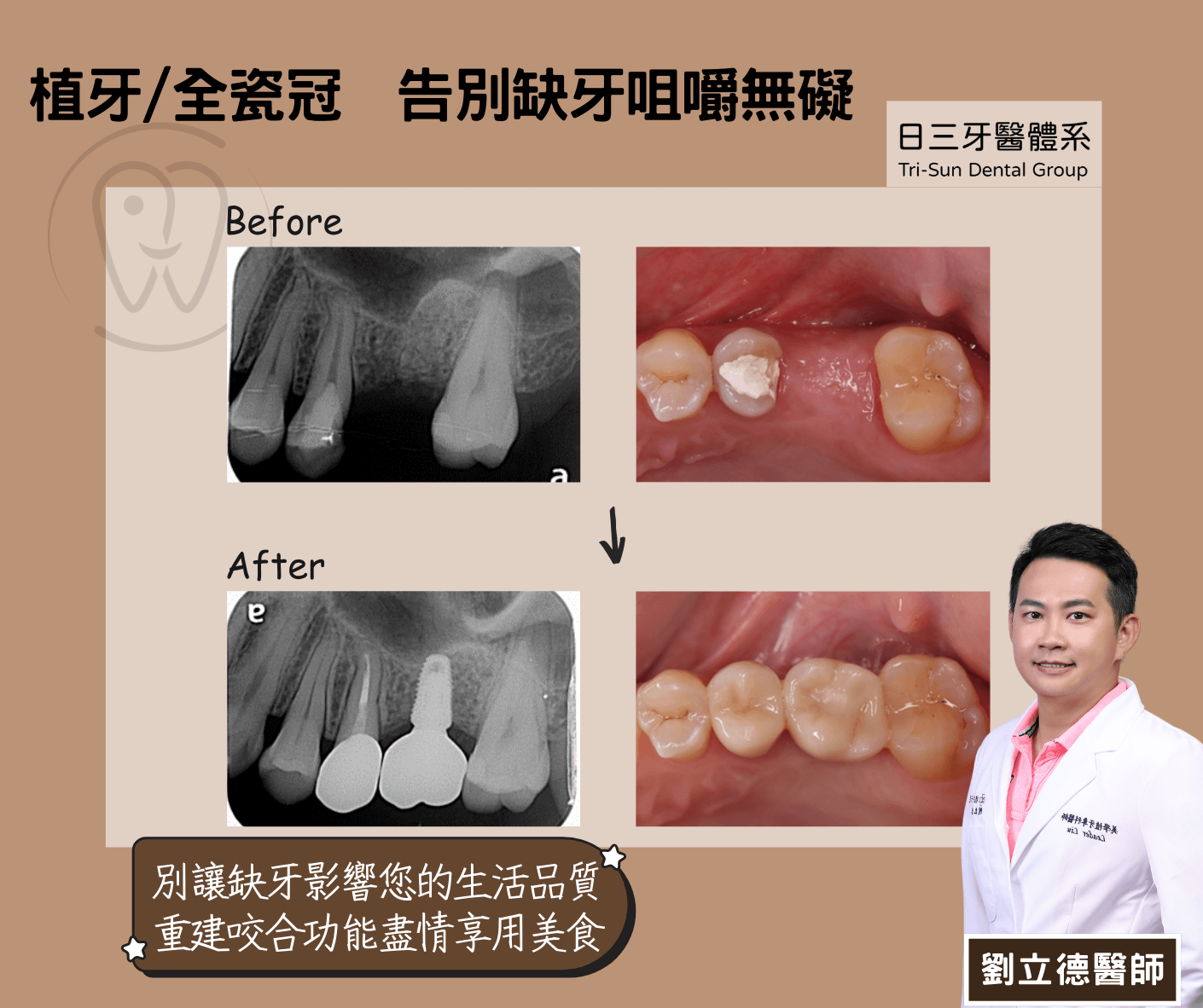 缺牙不補會怎樣?詳解缺牙風險、例外狀況,與 4 種補牙方式 植牙與全瓷冠的缺牙修復方案