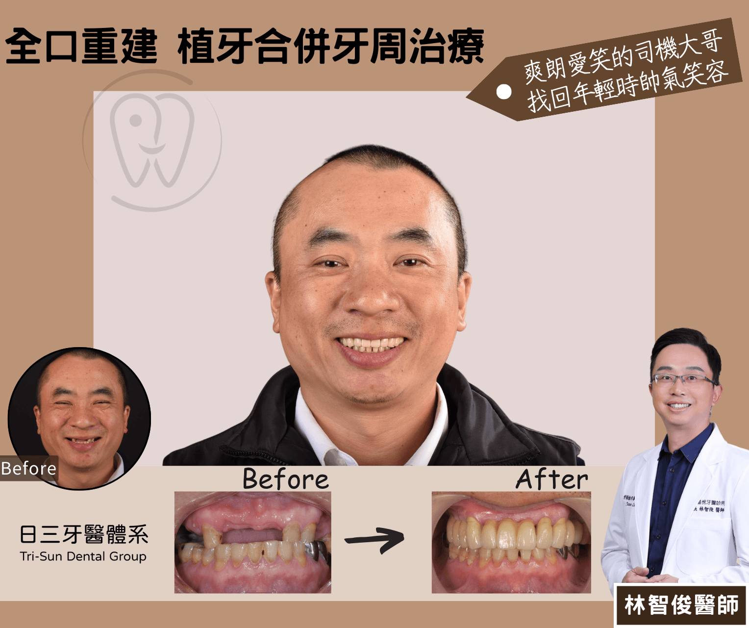 缺牙不補會怎樣?詳解缺牙風險、例外狀況,與 4 種補牙方式 植牙與牙周病治療缺牙案例
